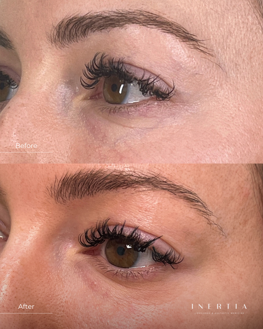 C.H. periocular vein treatment therapy