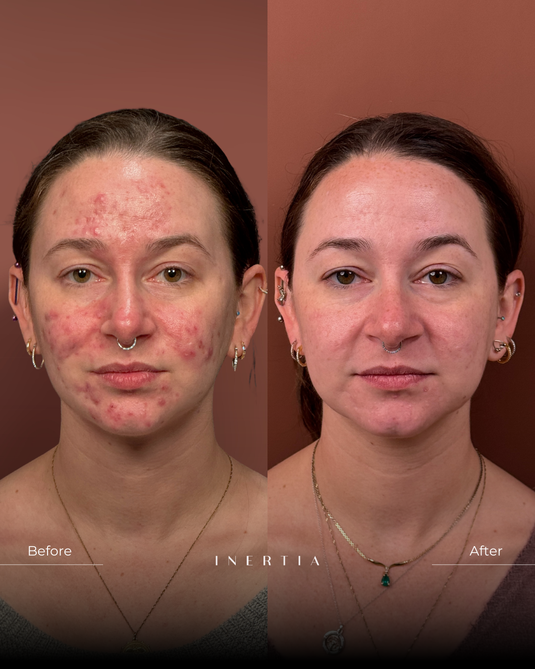 Aviclear for Acne in Tampa, FL The first and only FDA-cleared laser that targets acne at its source—the sebaceous glands—for lasting, medication-free results in both adolescents and adults. Safe for all skin types, it’s a powerful alternative to Accutane, rebalancing oil production, reducing breakouts, and revealing clearer, healthier skin without side effects.