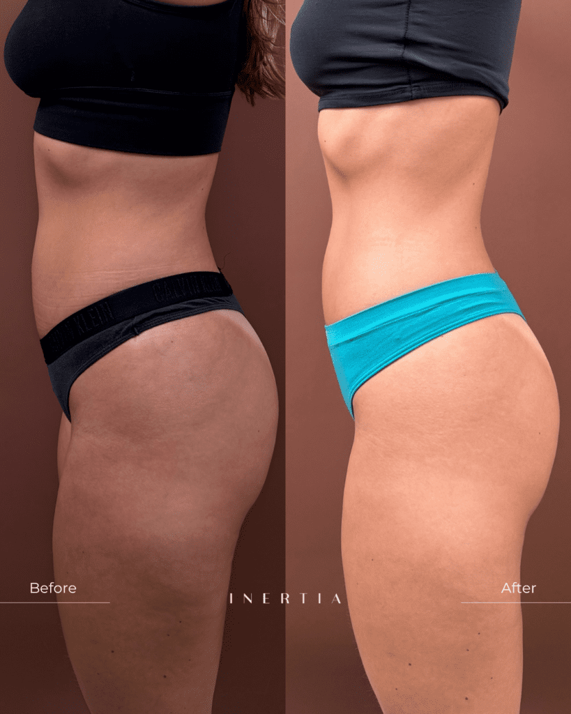 Emsculpt NEO before & afters Tampa FL