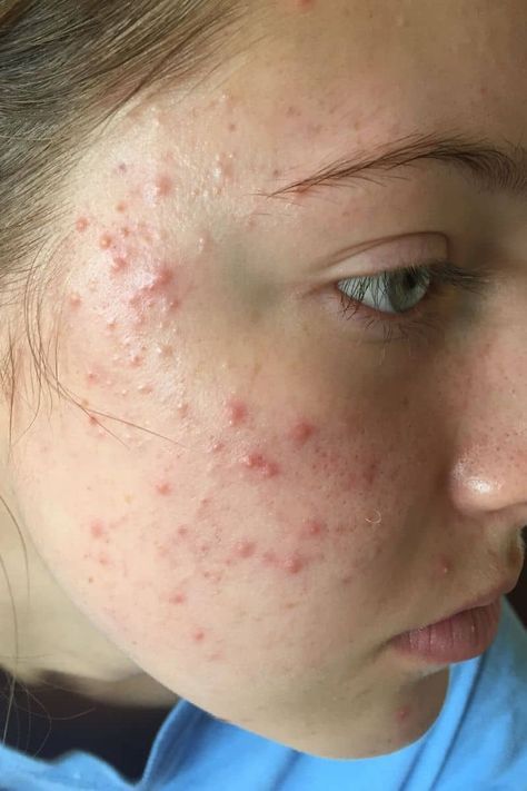 teenacne blogimage (002)