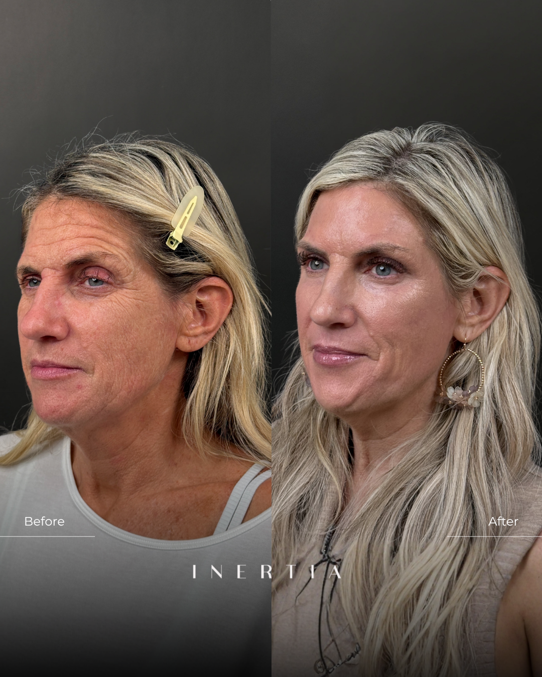 Before & After Deep Resurfacing with Contour TRL