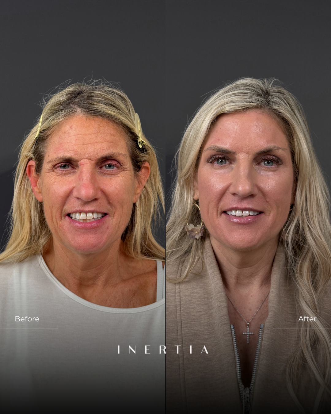 Before & After Deep Resurfacing with Contour TRL