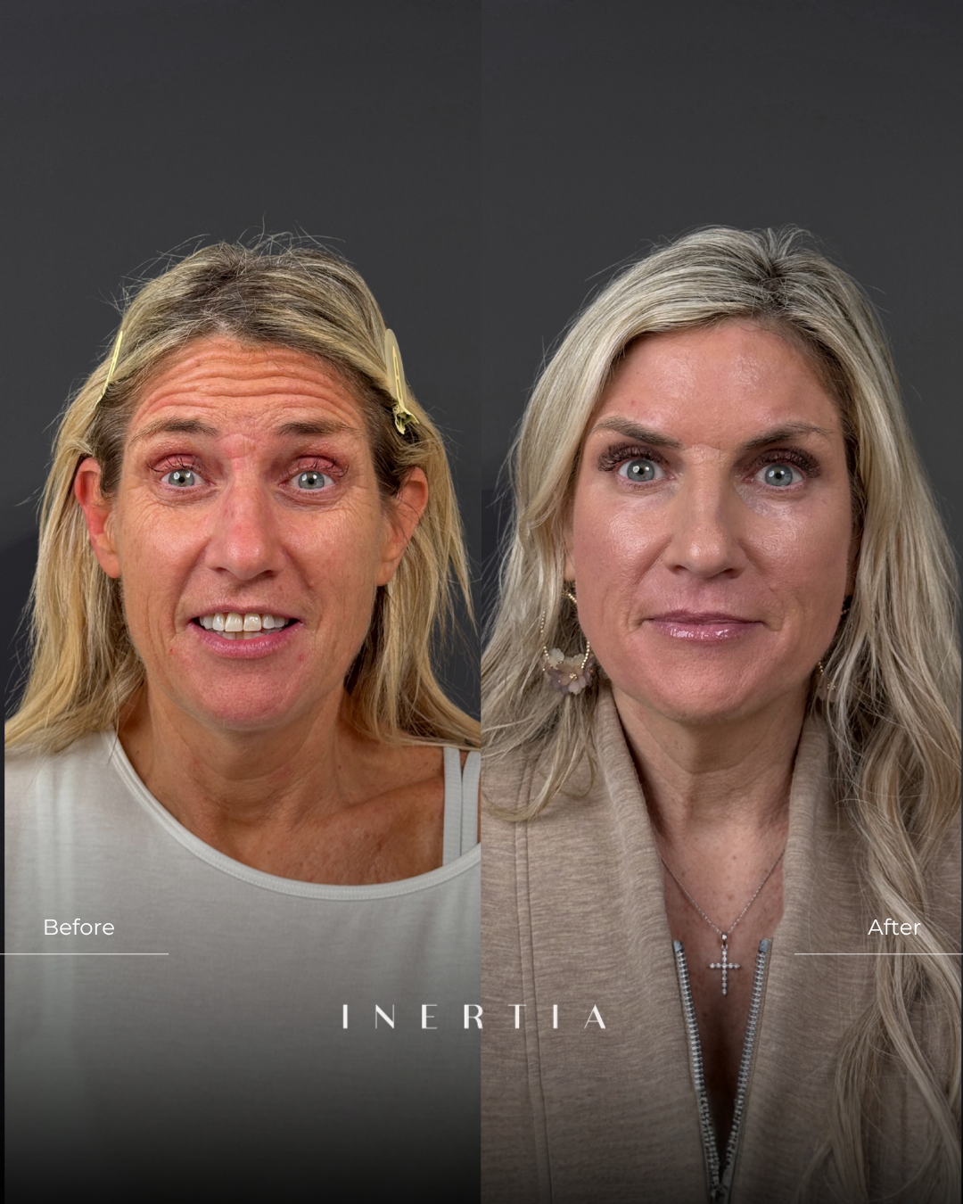 Before & After Expression Face | Deep Resurfacing with Contour TRL