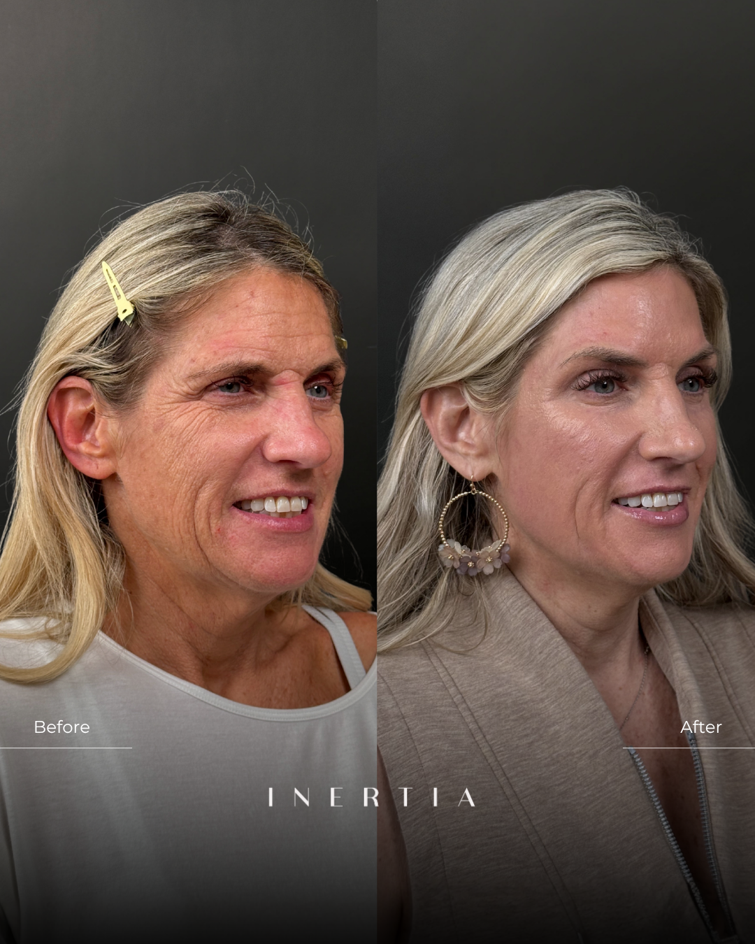 Before & After | Deep Resurfacing with Contour TRL
