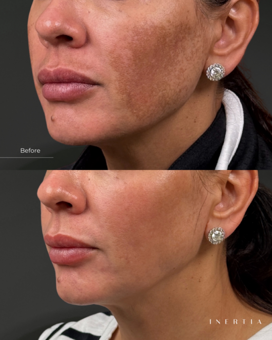 Melasma Picogensis
