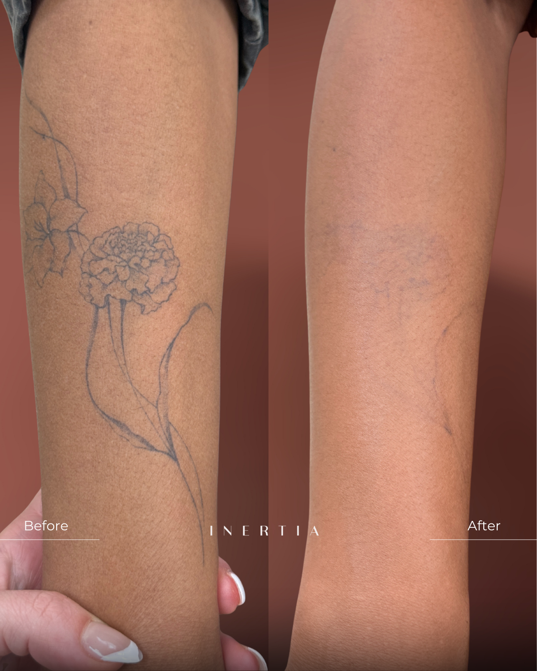 Tattoo removal