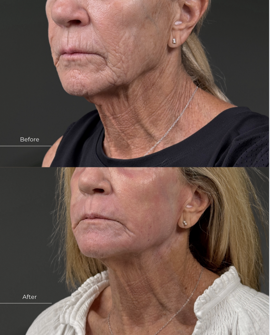 Deep laser resurfacing