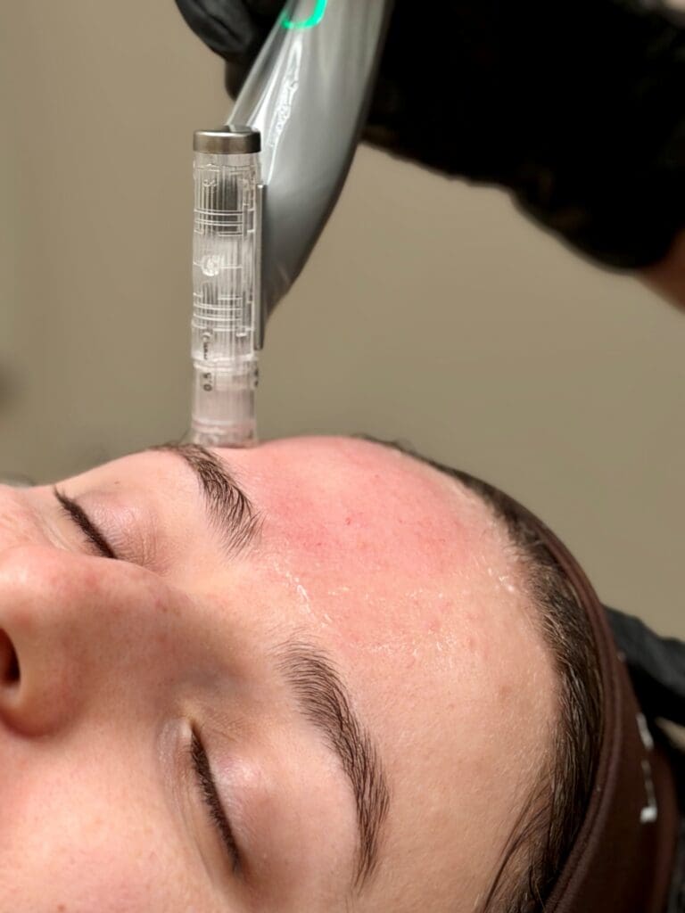 Micro needling