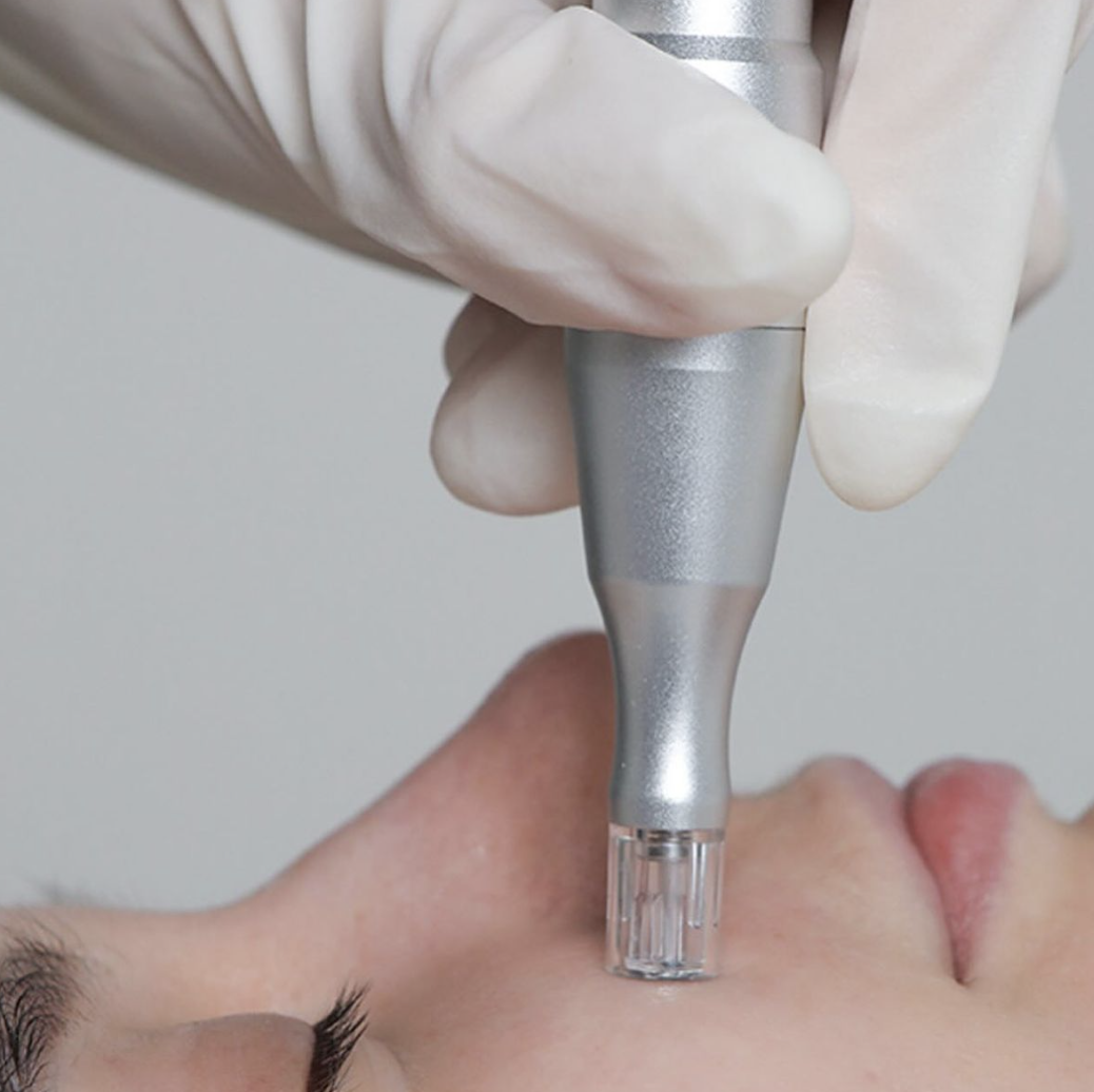 Microneedling