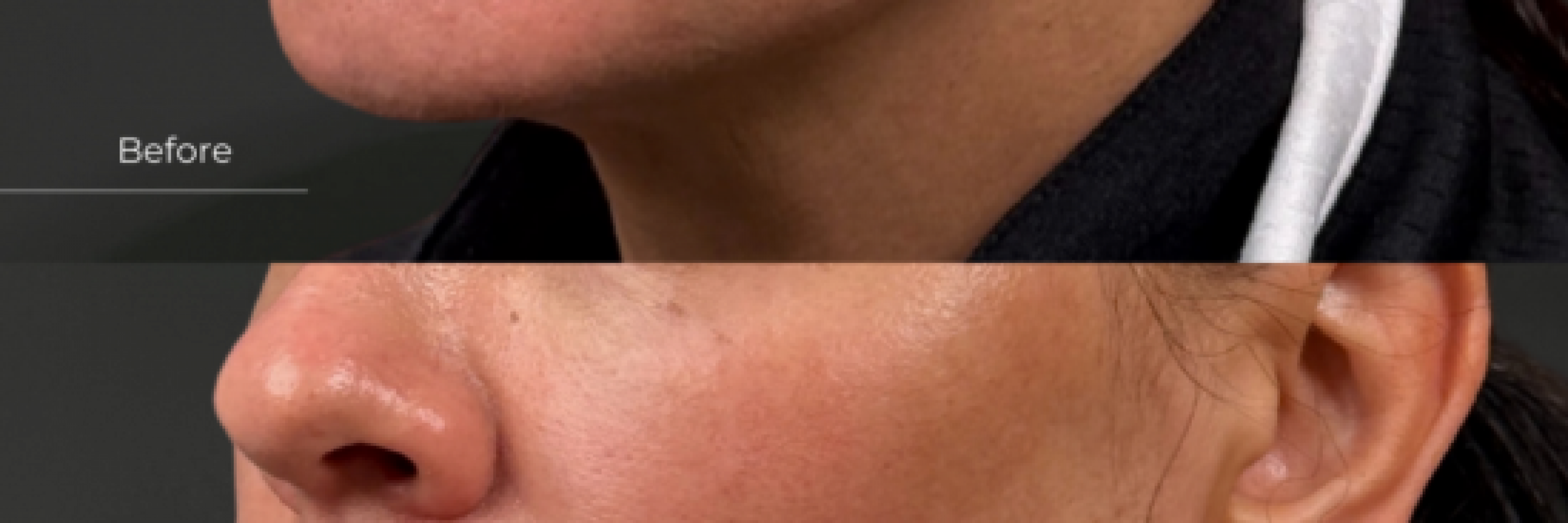Melasma Picogensis