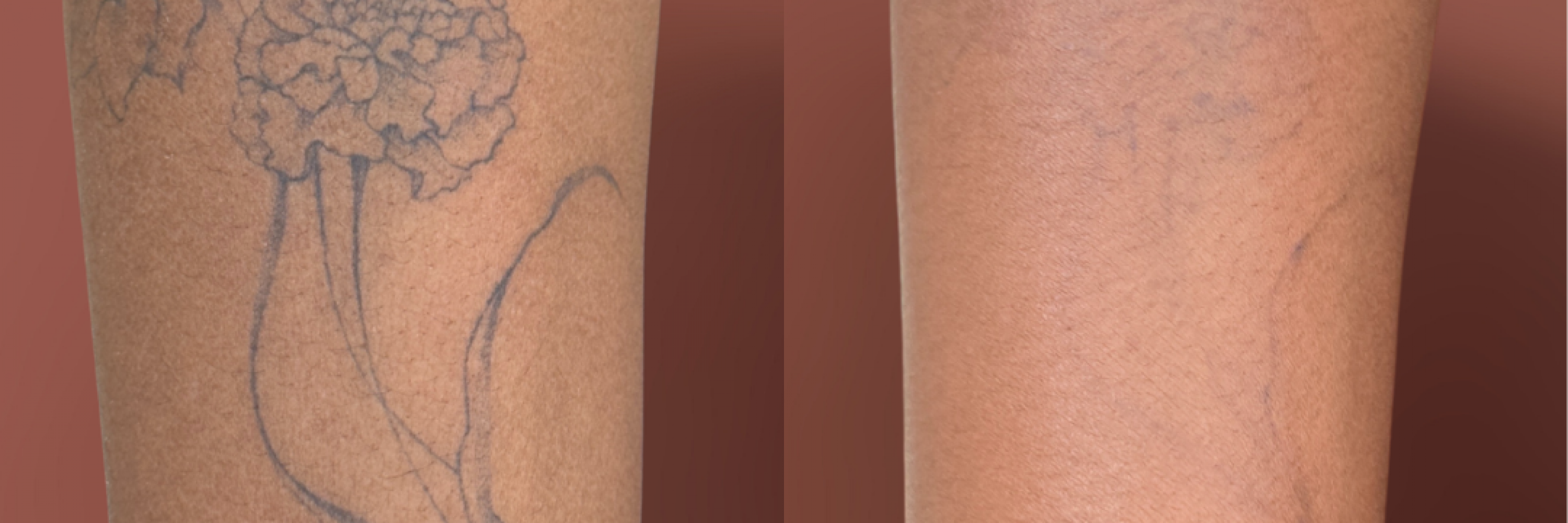 Tattoo removal